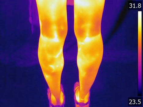 Aumento de temperatura debido a las varices (circulación venosa) en las piernas.