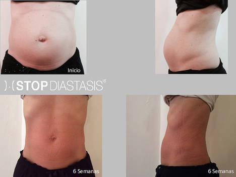 StopDiastasis, un método revolucionario para conseguir un abdomen plano tras el embarazo