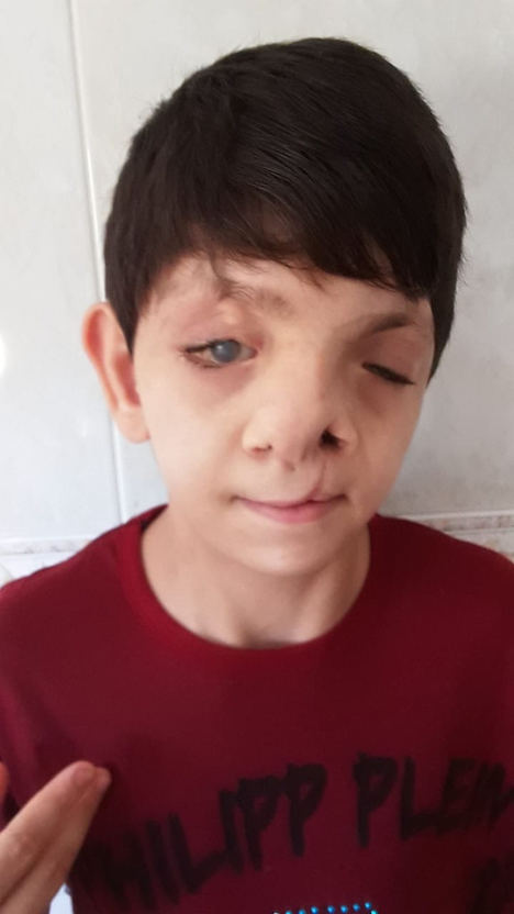 Fundación Adelias busca ayuda para operar a un menor con graves malformaciones en la cara