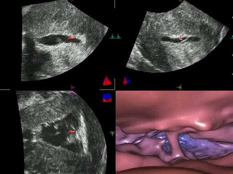 Pólipos y adherencia en cavidad uterina visualizadas en 2 y 3 dimensiones.