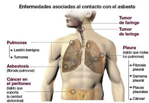 El problema invisible del Amianto